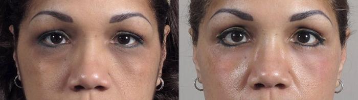 Eyelid Lift Case 105 Before & After View #1 | Paramus, New Jersey | Parker Center for Plastic Surgery