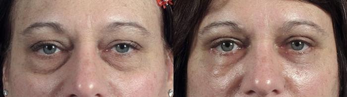 Eyelid Lift Case 106 Before & After View #1 | Paramus, New Jersey | Parker Center for Plastic Surgery
