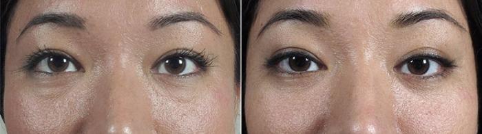 Eyelid Lift Case 108 Before & After View #1 | Paramus, New Jersey | Parker Center for Plastic Surgery