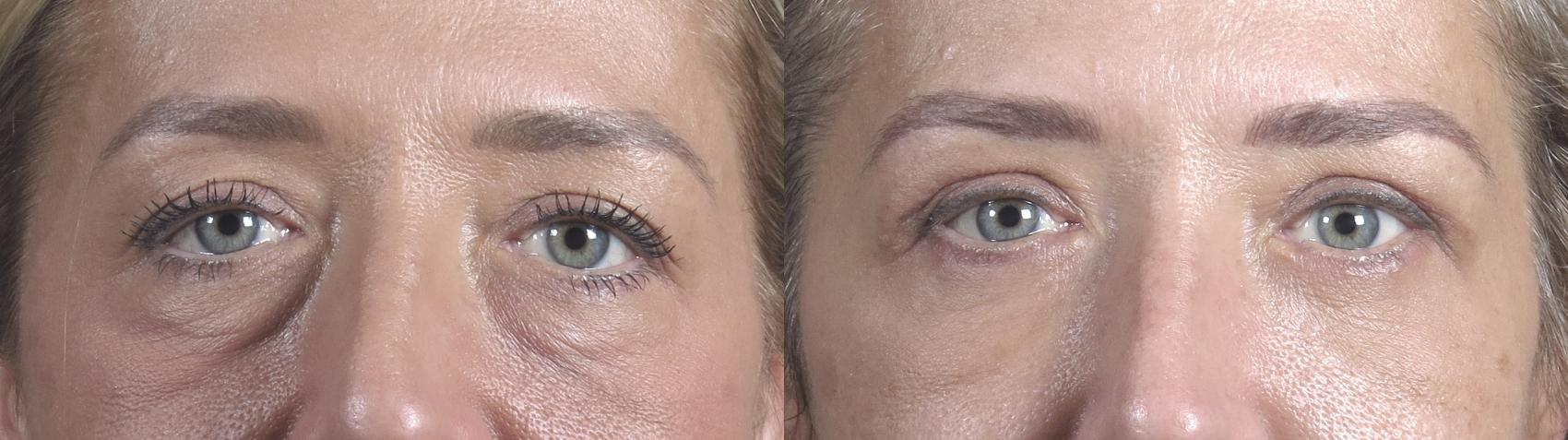 Eyelid Lift Case 1092 Before & After Close up eyes | Paramus, New Jersey | Parker Center for Plastic Surgery