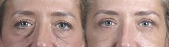 Eyelid Lift Case 1092 Before & After Close up eyes | Paramus, New Jersey | Parker Center for Plastic Surgery