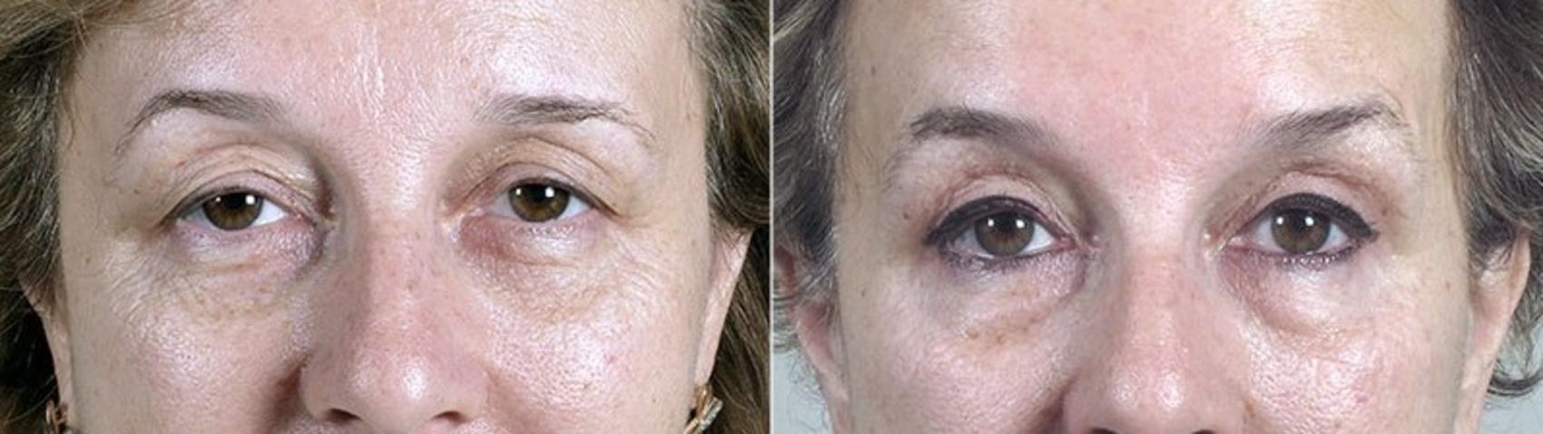 Eyelid Lift Case 110 Before & After View #1 | Paramus, New Jersey | Parker Center for Plastic Surgery