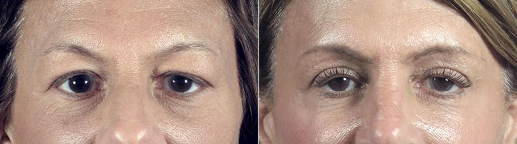 Eyelid Lift Case 111 Before & After View #1 | Paramus, New Jersey | Parker Center for Plastic Surgery
