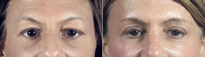 Eyelid Lift Case 111 Before & After View #1 | Paramus, New Jersey | Parker Center for Plastic Surgery