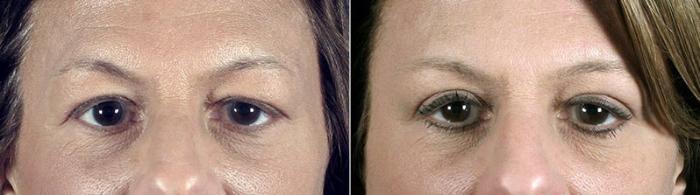 Eyelid Lift Case 111 Before & After View #2 | Paramus, New Jersey | Parker Center for Plastic Surgery