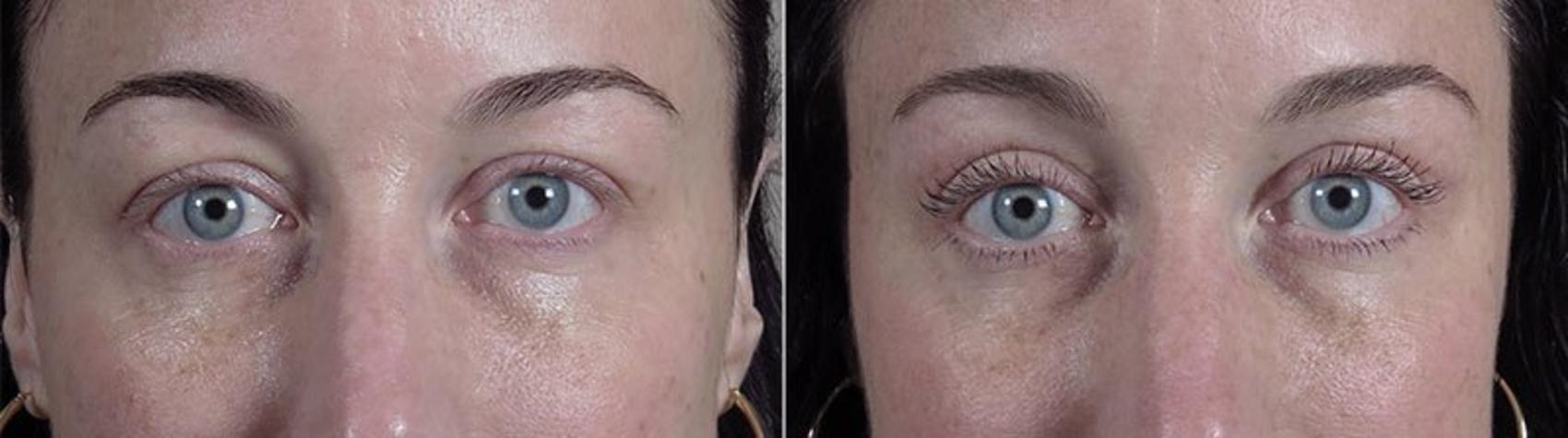 Eyelid Lift Case 113 Before & After View #1 | Paramus, New Jersey | Parker Center for Plastic Surgery