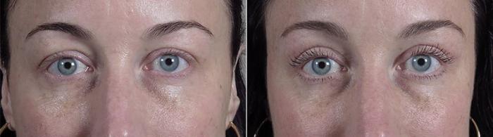 Eyelid Lift Case 113 Before & After View #1 | Paramus, New Jersey | Parker Center for Plastic Surgery