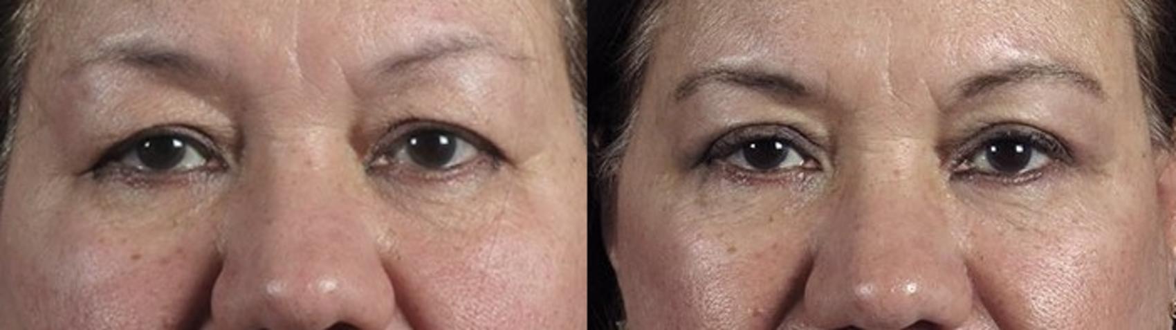 Eyelid Lift Case 1169 Before & After View 1  | Paramus, New Jersey | Parker Center for Plastic Surgery