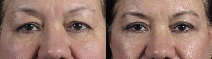 Eyelid Lift Case 1169 Before & After View 1  | Paramus, New Jersey | Parker Center for Plastic Surgery