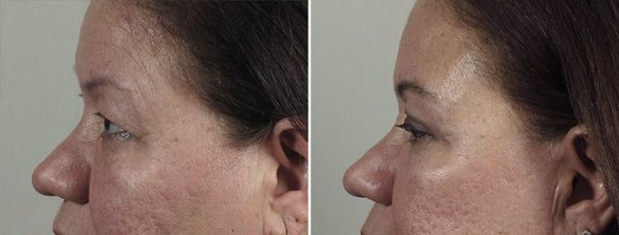 Eyelid Lift Case 1169 Before & After View 2 | Paramus, New Jersey | Parker Center for Plastic Surgery