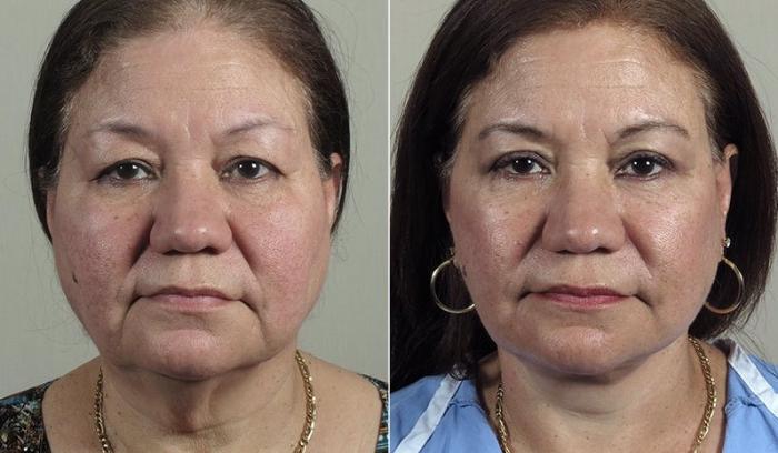 Eyelid Lift Case 1169 Before & After View 3 | Paramus, New Jersey | Parker Center for Plastic Surgery