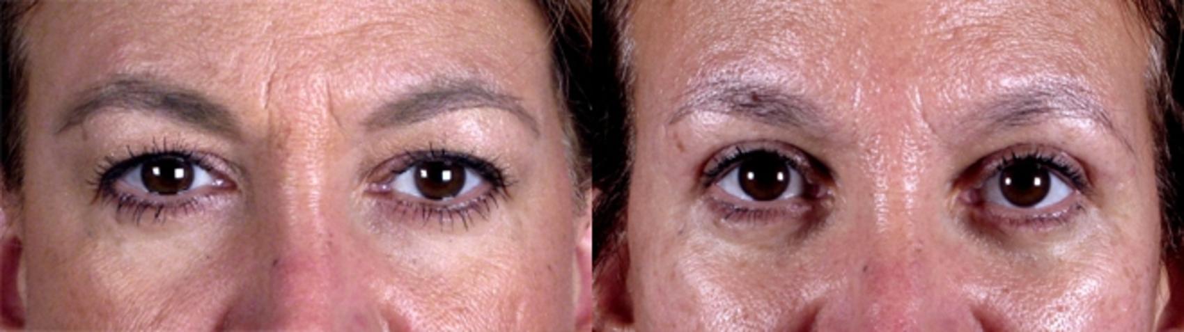Eyelid Lift Case 1173 Before & After View 1  | Paramus, New Jersey | Parker Center for Plastic Surgery