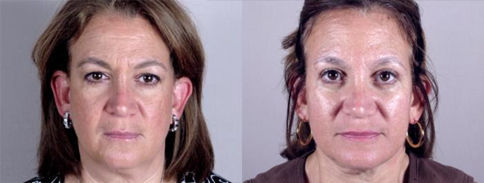 Eyelid Lift Case 1173 Before & After View 2 | Paramus, New Jersey | Parker Center for Plastic Surgery