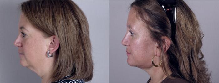 Eyelid Lift Case 1173 Before & After View 3 | Paramus, New Jersey | Parker Center for Plastic Surgery