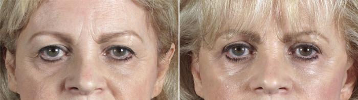 Eyelid Lift Case 1174 Before & After View 1  | Paramus, New Jersey | Parker Center for Plastic Surgery