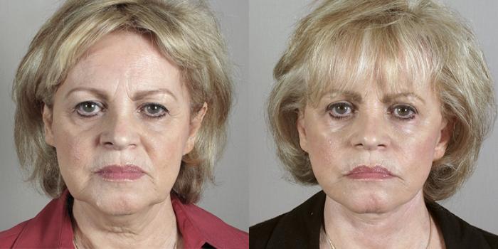 Eyelid Lift Case 1174 Before & After View 2 | Paramus, New Jersey | Parker Center for Plastic Surgery