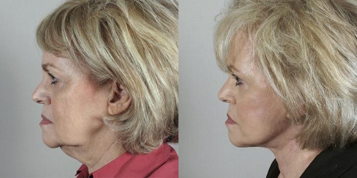 Eyelid Lift Case 1174 Before & After View 3 | Paramus, New Jersey | Parker Center for Plastic Surgery