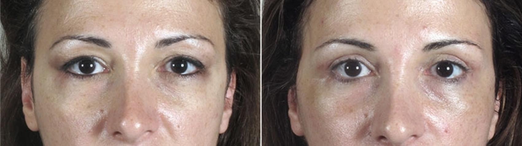 Eyelid Lift Case 1175 Before & After View 1  | Paramus, New Jersey | Parker Center for Plastic Surgery