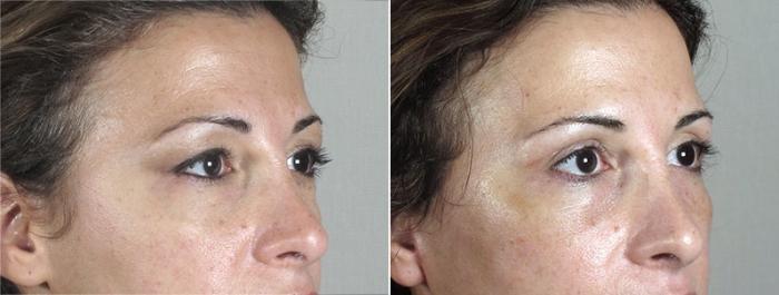 Eyelid Lift Case 1175 Before & After View 2 | Paramus, New Jersey | Parker Center for Plastic Surgery