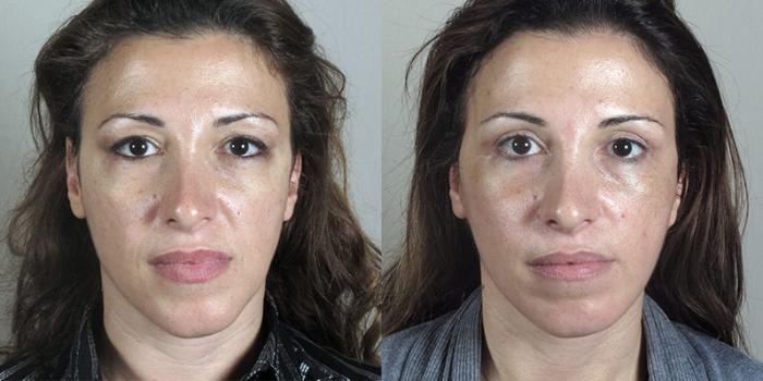 Eyelid Lift Case 1175 Before & After View 3 | Paramus, New Jersey | Parker Center for Plastic Surgery