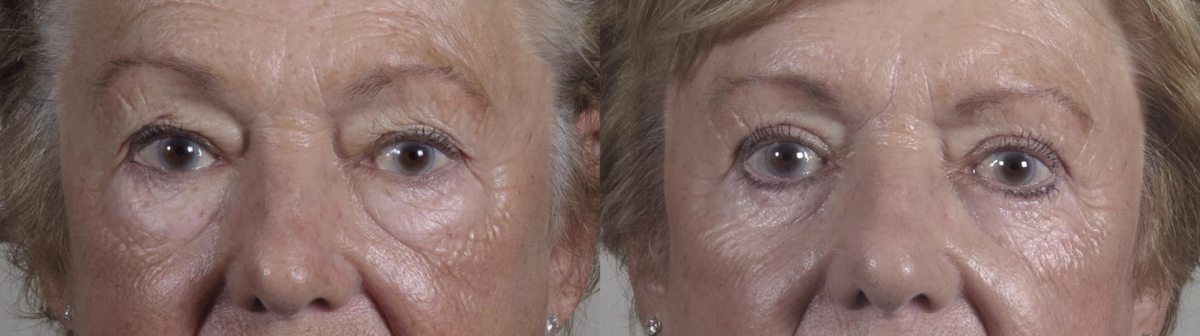 Eyelid Lift Case 1213 Before & After View #1  | Paramus, New Jersey | Parker Center for Plastic Surgery