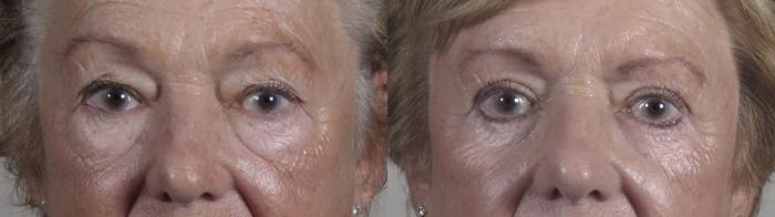 Eyelid Lift Case 1213 Before & After View #1  | Paramus, New Jersey | Parker Center for Plastic Surgery