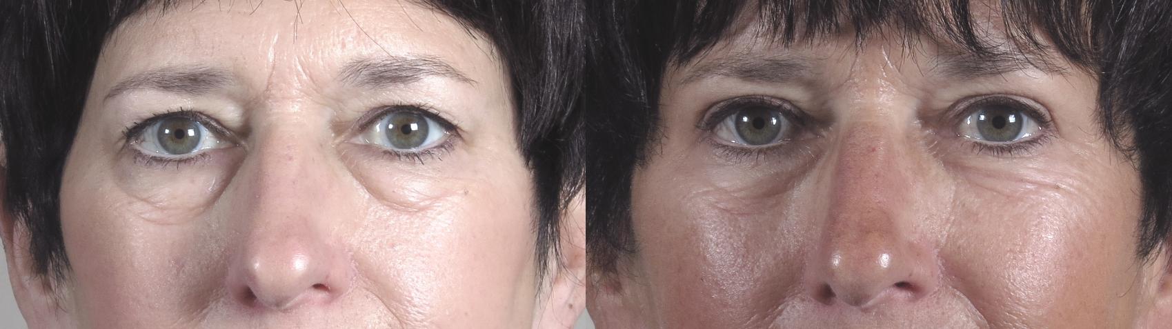 Eyelid Lift Case 1214 Before & After View #1  | Paramus, New Jersey | Parker Center for Plastic Surgery