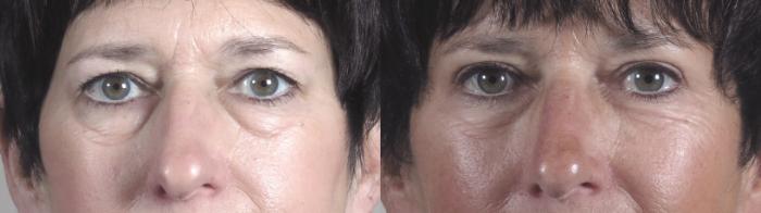 Eyelid Lift Case 1214 Before & After View #1  | Paramus, New Jersey | Parker Center for Plastic Surgery