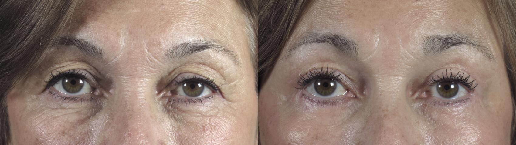 Eyelid Lift Case 1291 Before & After Front | Paramus, New Jersey | Parker Center for Plastic Surgery