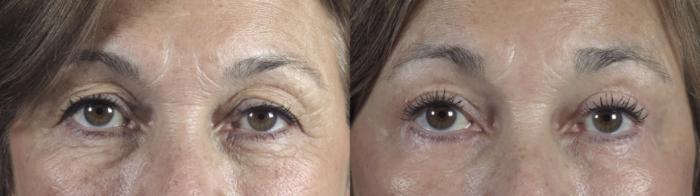 Eyelid Lift Case 1291 Before & After Front | Paramus, New Jersey | Parker Center for Plastic Surgery