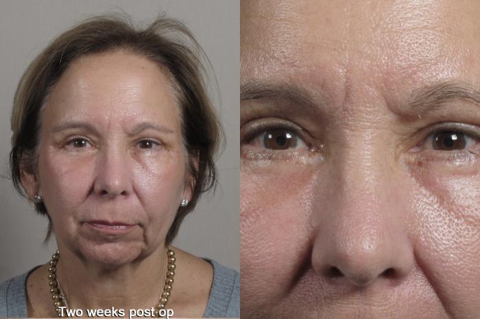 Eyelid Lift Case 1351 Before & After 2 weeks  | Paramus, New Jersey | Parker Center for Plastic Surgery
