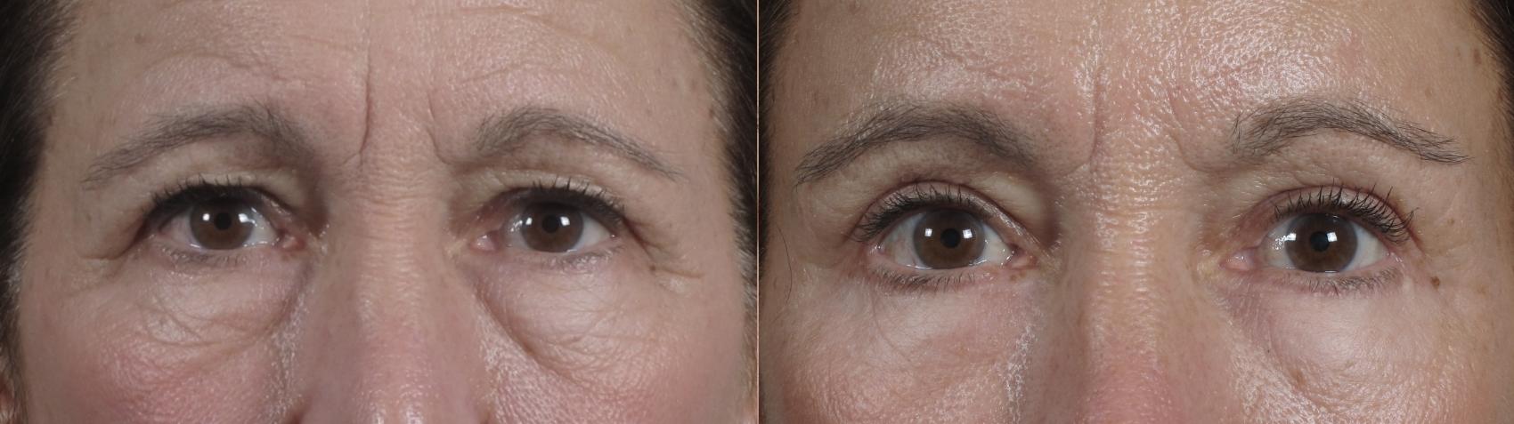 Eyelid Lift Case 1351 Before & After pre op  | Paramus, New Jersey | Parker Center for Plastic Surgery