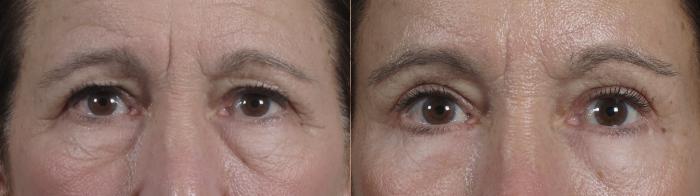Eyelid Lift Case 1351 Before & After pre op  | Paramus, New Jersey | Parker Center for Plastic Surgery