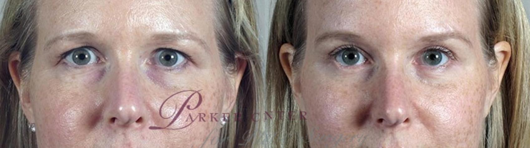 Eyelid Lift Case 1385 Before & After Front | Paramus, New Jersey | Parker Center for Plastic Surgery