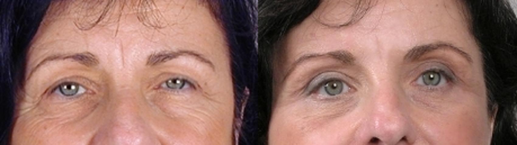 Eyelid Lift Case 1386 Before & After Front | Paramus, New Jersey | Parker Center for Plastic Surgery