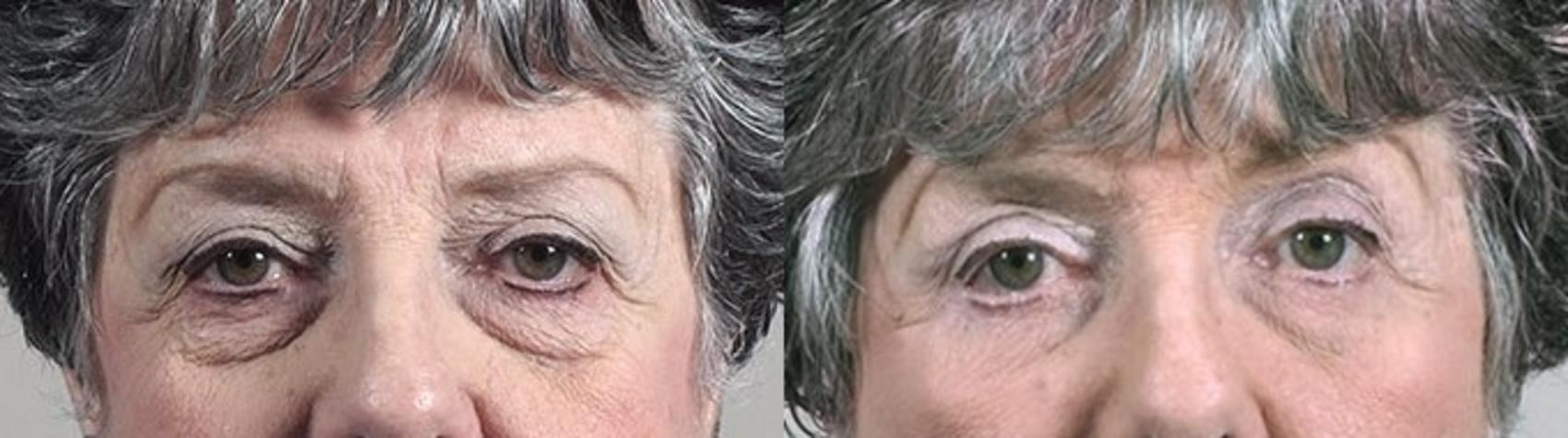 Eyelid Lift Case 1388 Before & After Front | Paramus, New Jersey | Parker Center for Plastic Surgery