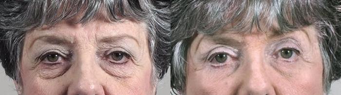Eyelid Lift Case 1388 Before & After Front | Paramus, New Jersey | Parker Center for Plastic Surgery