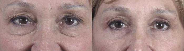 Eyelid Lift Case 1389 Before & After Front View | Paramus, New Jersey | Parker Center for Plastic Surgery
