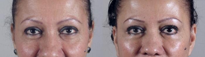 Eyelid Lift Case 1420 Before & After Front | Paramus, New Jersey | Parker Center for Plastic Surgery