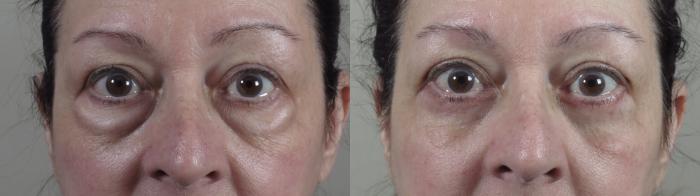 Eyelid Lift Case 1426 Before & After zoomed in  | Paramus, New Jersey | Parker Center for Plastic Surgery