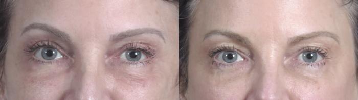 Eyelid Lift Case 1467 Before & After Front | Paramus, New Jersey | Parker Center for Plastic Surgery