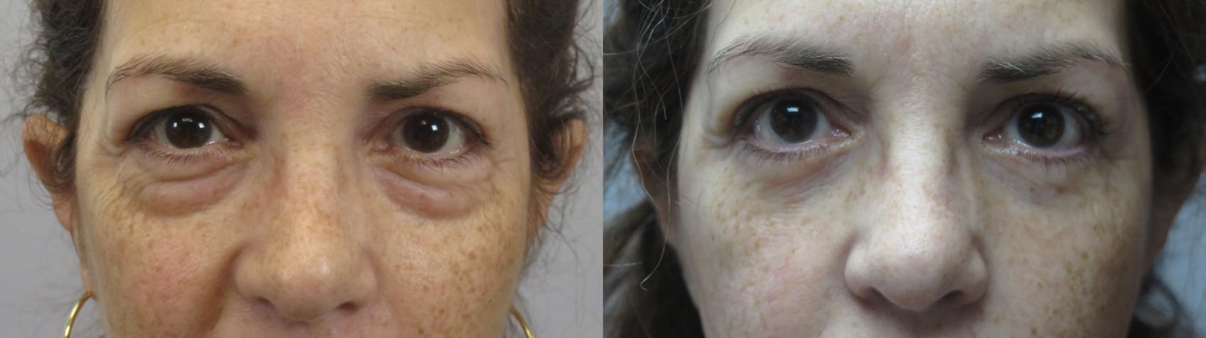 Eyelid Lift Case 1641 Before & After Front | Paramus, New Jersey | Parker Center for Plastic Surgery