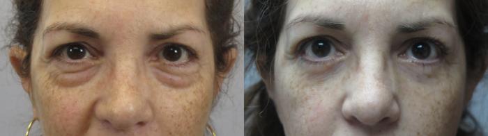 Eyelid Lift Case 1641 Before & After Front | Paramus, New Jersey | Parker Center for Plastic Surgery