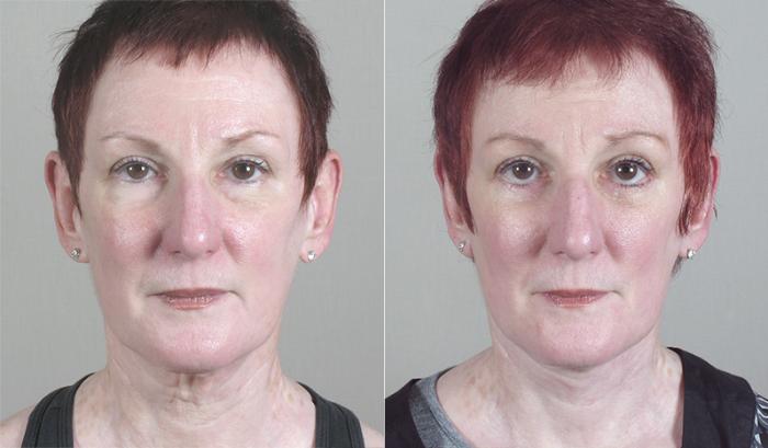 Eyelid Lift Case 26 Before & After View #1 | Paramus, New Jersey | Parker Center for Plastic Surgery