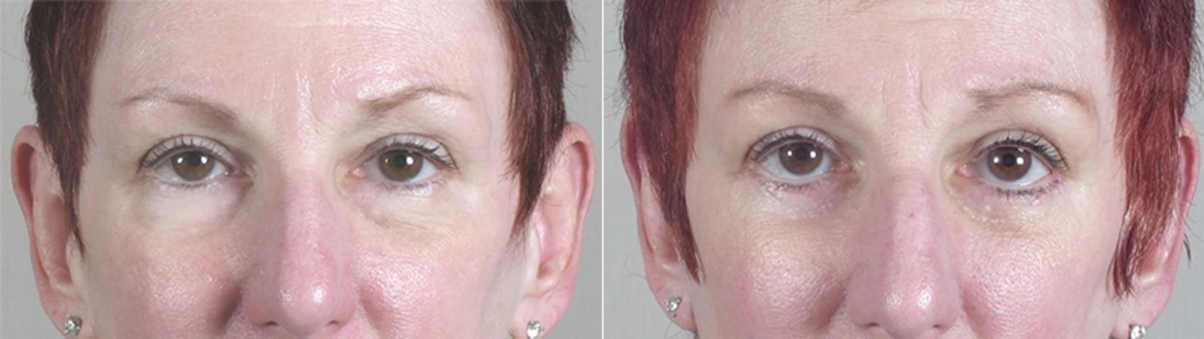 Eyelid Lift Case 26 Before & After View #11 | Paramus, New Jersey | Parker Center for Plastic Surgery