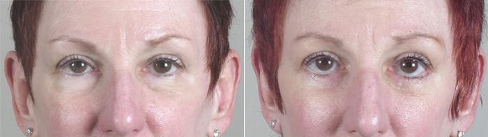 Eyelid Lift Case 26 Before & After View #11 | Paramus, New Jersey | Parker Center for Plastic Surgery