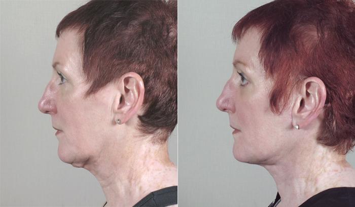Eyelid Lift Case 26 Before & After View #2 | Paramus, New Jersey | Parker Center for Plastic Surgery