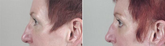 Eyelid Lift Case 26 Before & After View #4 | Paramus, New Jersey | Parker Center for Plastic Surgery