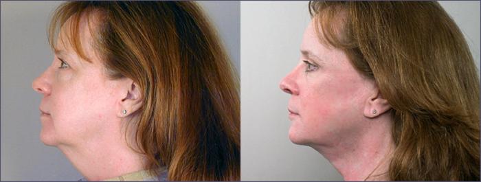 Eyelid Lift Case 4 Before & After View #2 | Paramus, New Jersey | Parker Center for Plastic Surgery