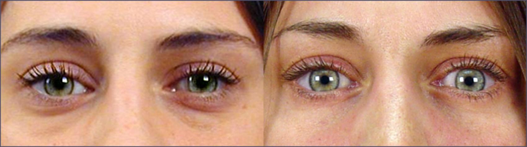 Eyelid Lift Case 54 Before & After View #1 | Paramus, New Jersey | Parker Center for Plastic Surgery